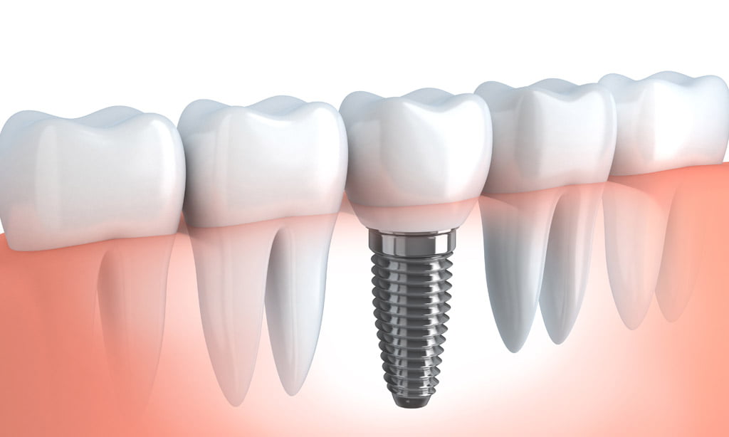 Dental Implants Surgery