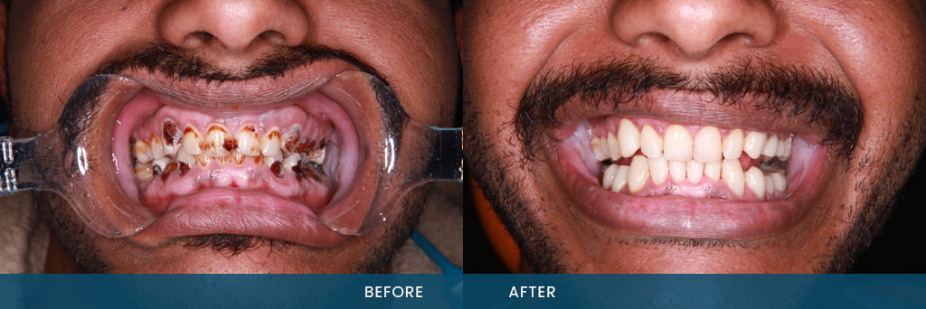 Porcelain Veneers Service