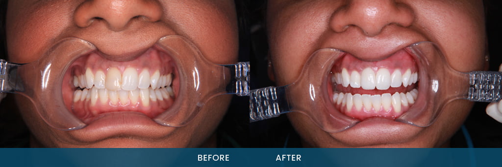 veneers