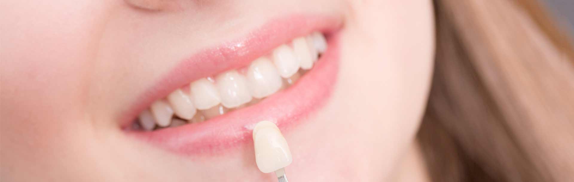 How to Find Best Porcelain Veneers Near Me Melbourne