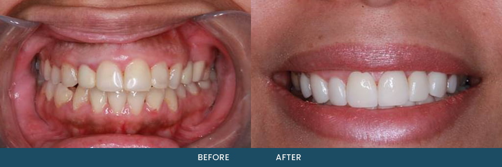 Porcelain Veneers Service