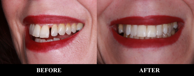 Cosmetic Dentistry Before After