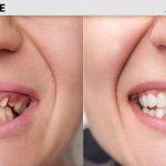 Find the reasonable dental implants cost with better treatment