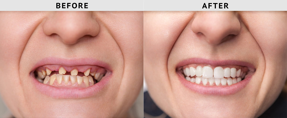 Find The Reasonable Dental Implants Cost With Better Treatment