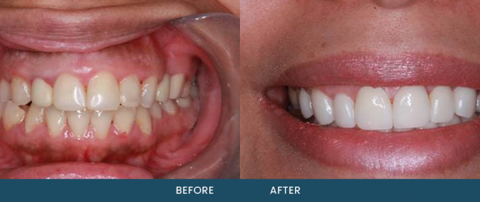 Internal tooth whitening