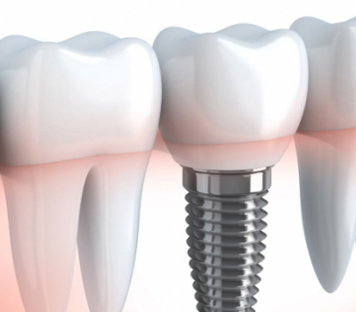 Dental implants, are they the right option for me?