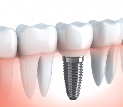 Getting dental implants in melbourne