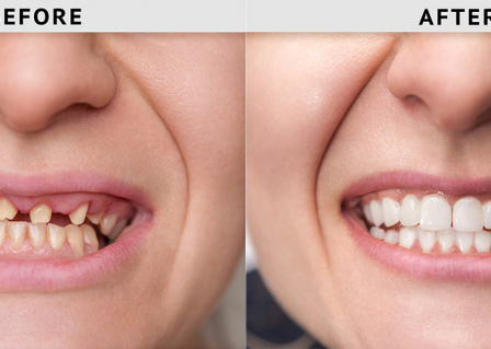 Find the reasonable dental implants cost with better treatment