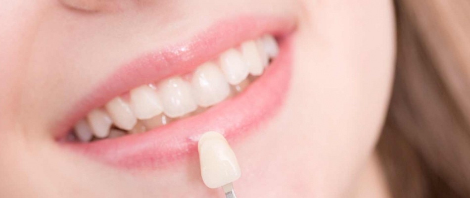 How to Find Best Porcelain Veneers Near Me Melbourne How to Find Best Porcelain Veneers Near Me Melbourne